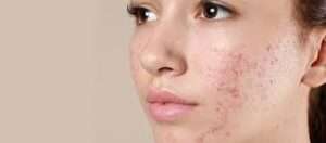 ACNE PRONE SKIN