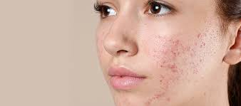 ACNE PRONE SKIN