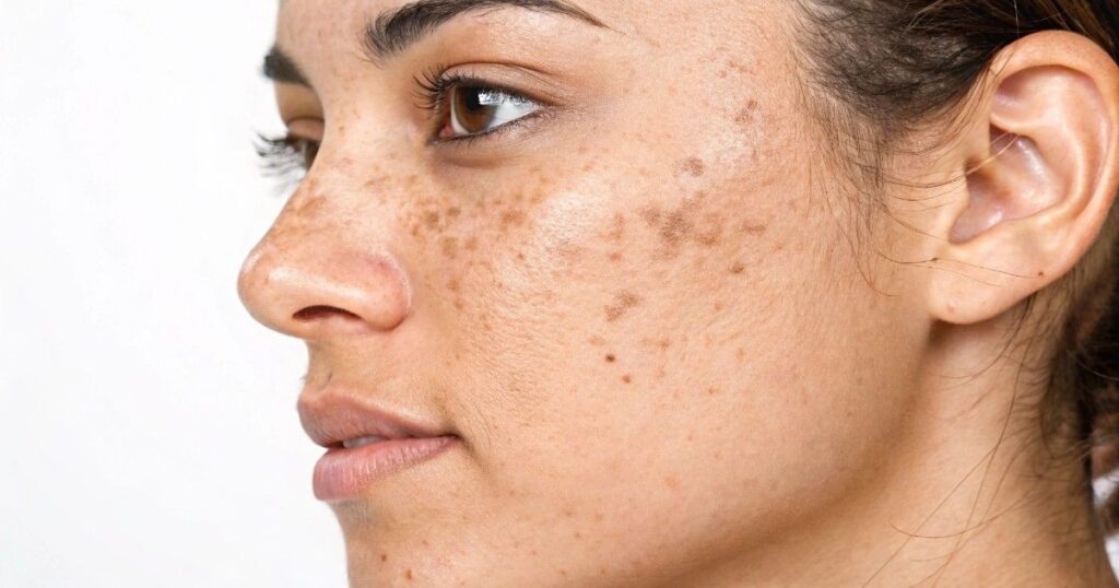 Skin specialist treating melasma for clearer and more even skin tone