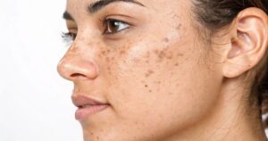 Skin specialist treating melasma for clearer and more even skin tone